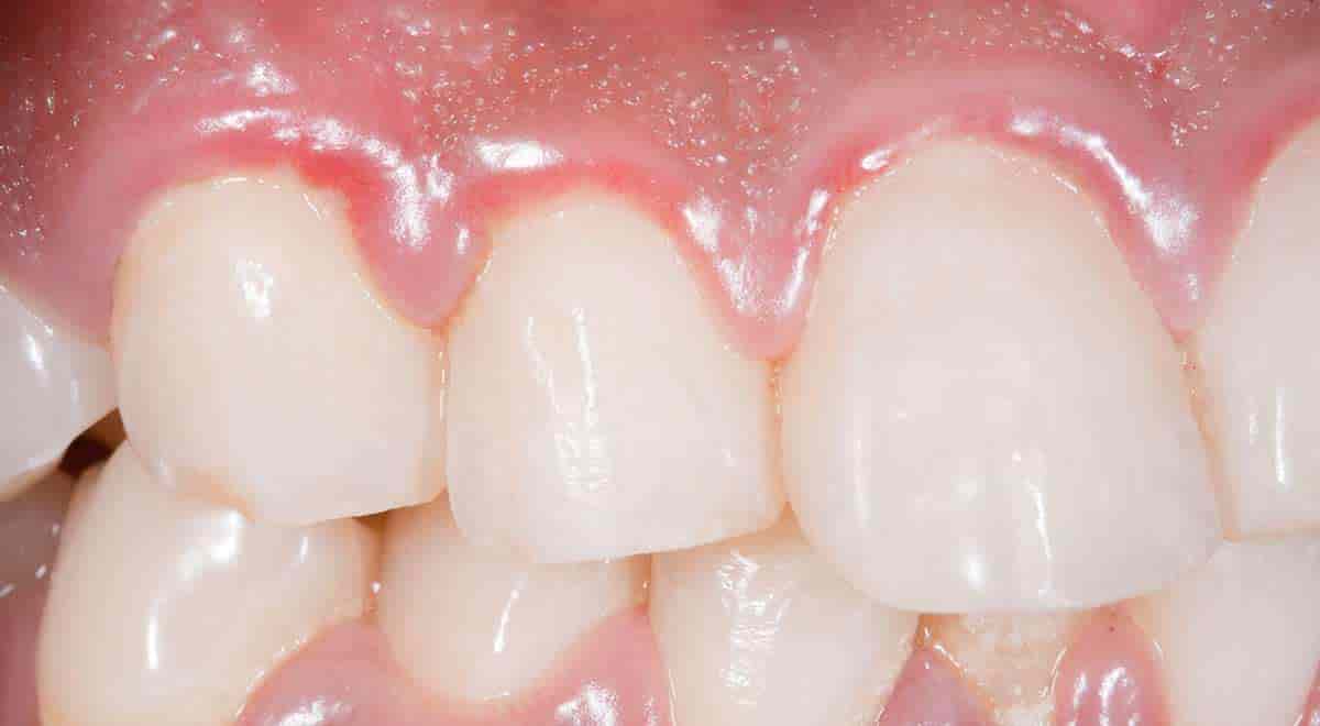 Quality-Dental-Sydney-sore-gums