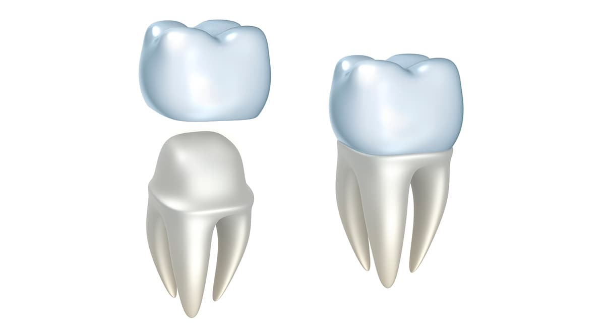 A porcelain crown is a tooth like cap made out of a type of ceramic material.