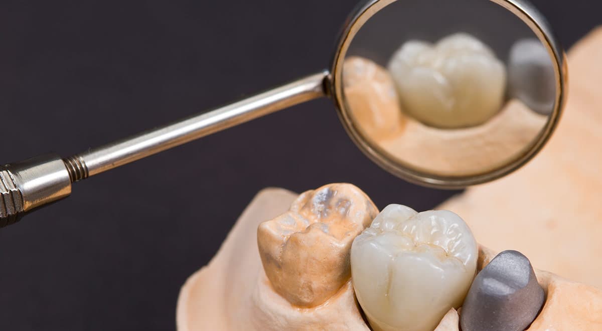 Dental crown is important in restoring the function of your tooth.