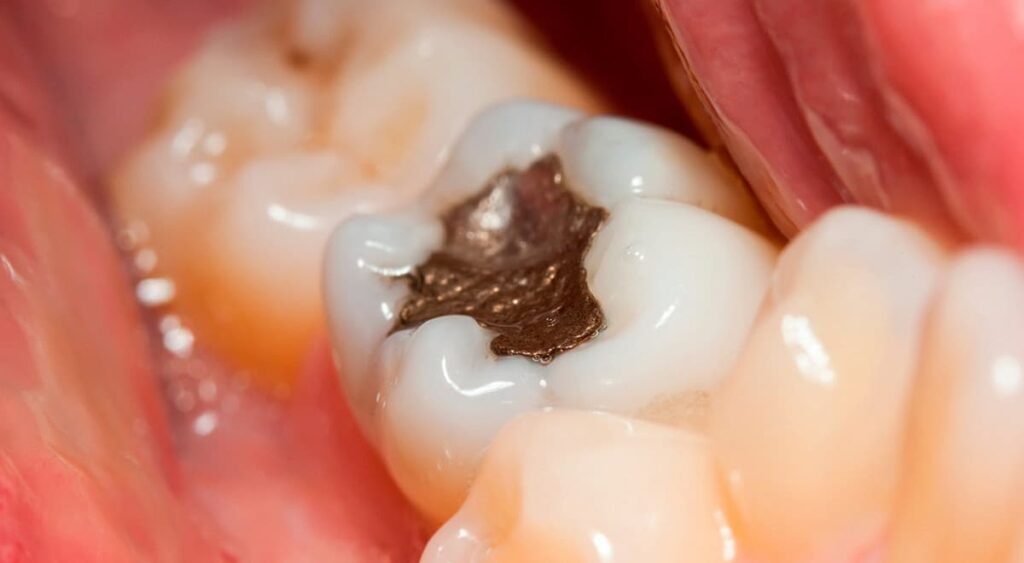 Amalgam Dental Fillings