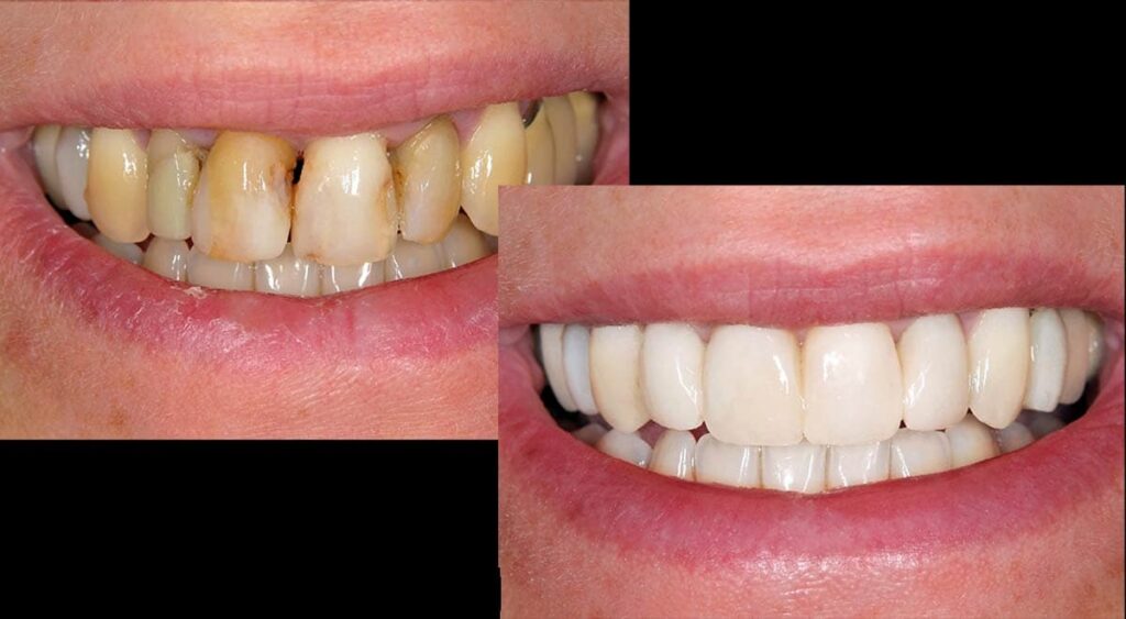 Complete Smile Makeover Before And After