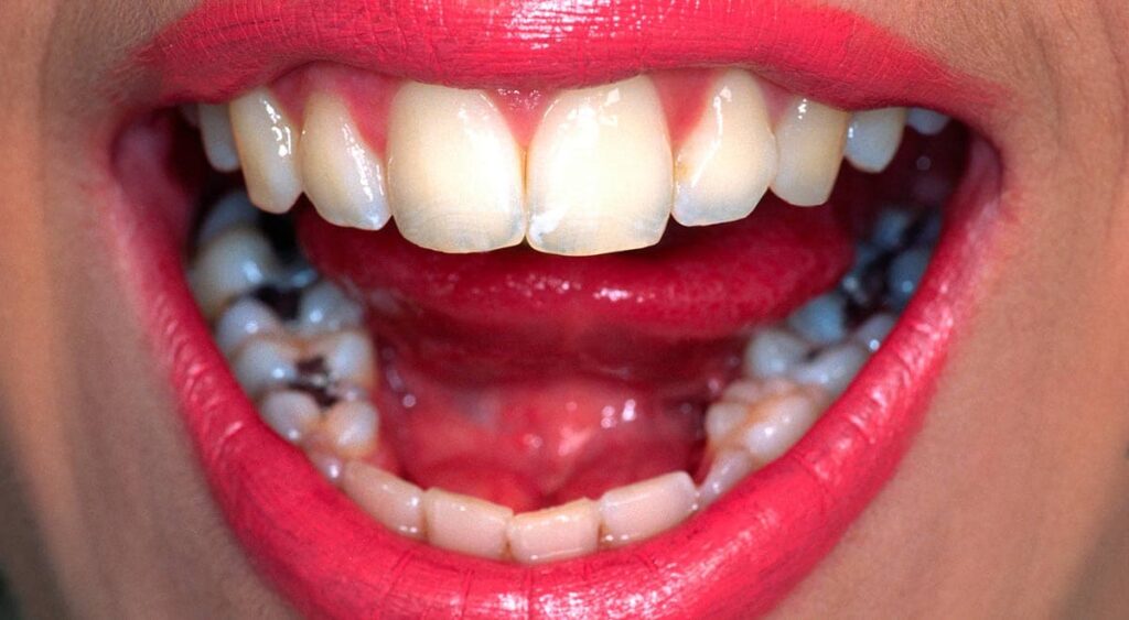 Composite Fillings Lady With Mouth Open