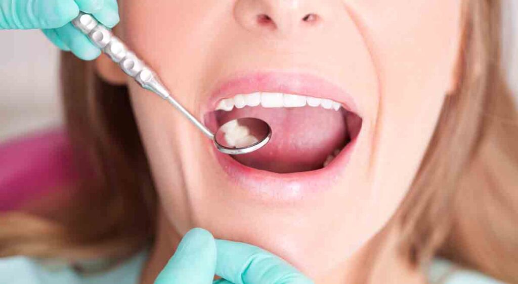 Dental Fillings