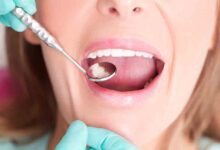 Dental Fillings