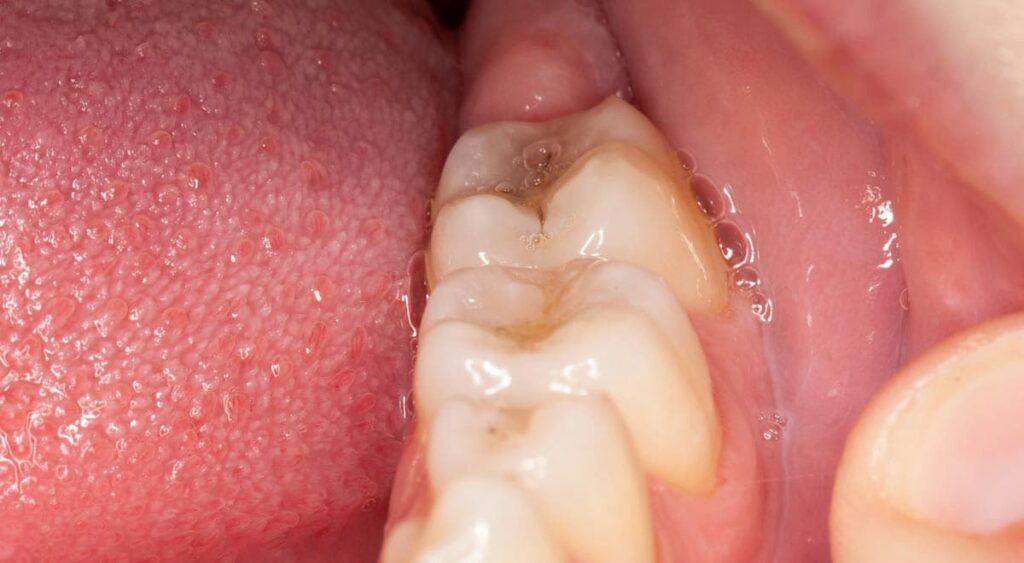 Dental Fillings Close Up