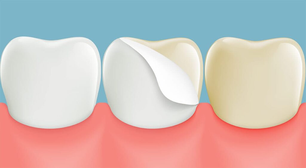 Dental Stains Teeth Image