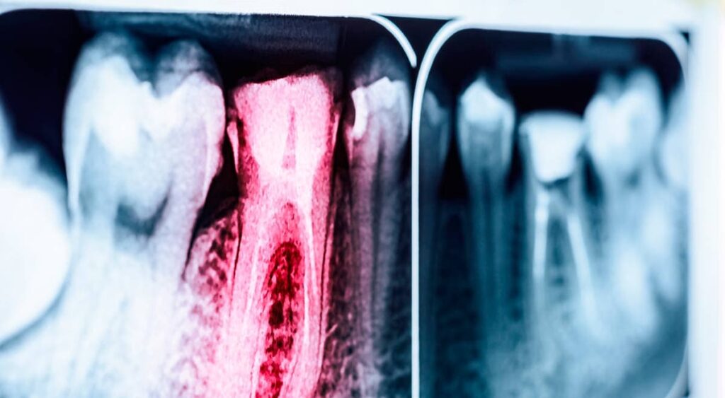 Root Canal Myths x-ray