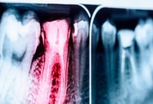 Root Canal Myths x-ray