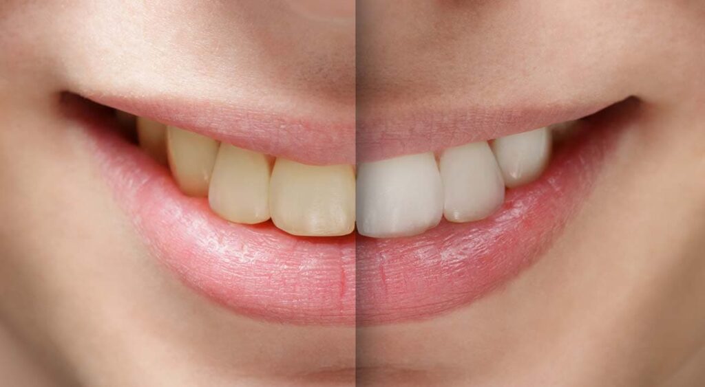 Teeth Whitening Solutions Before And After