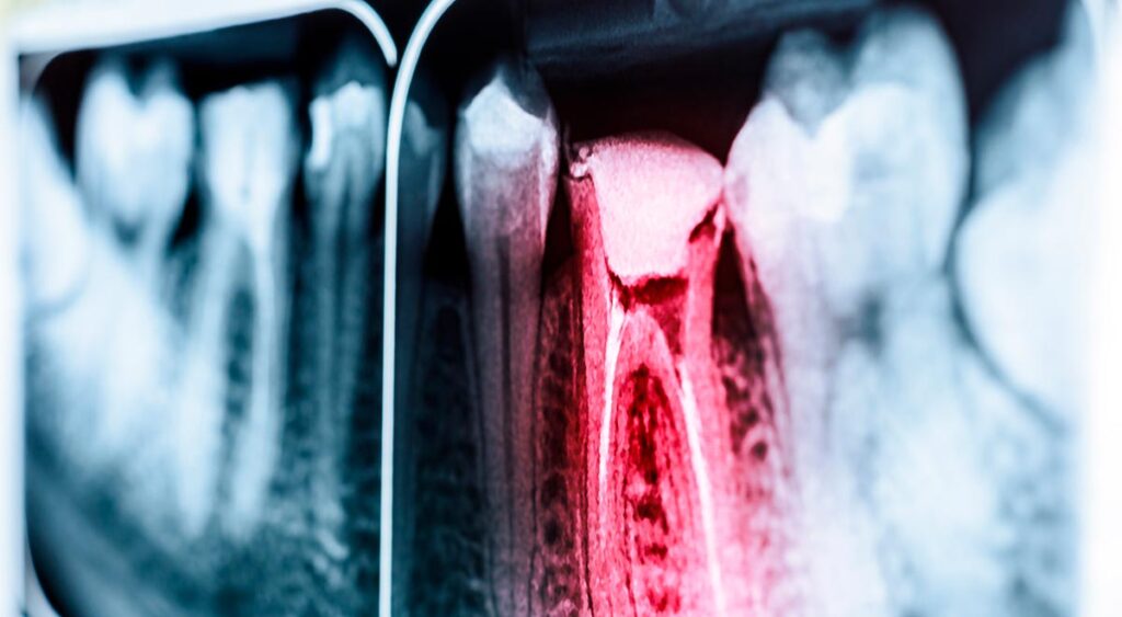 Tooth Root Canal x-ray