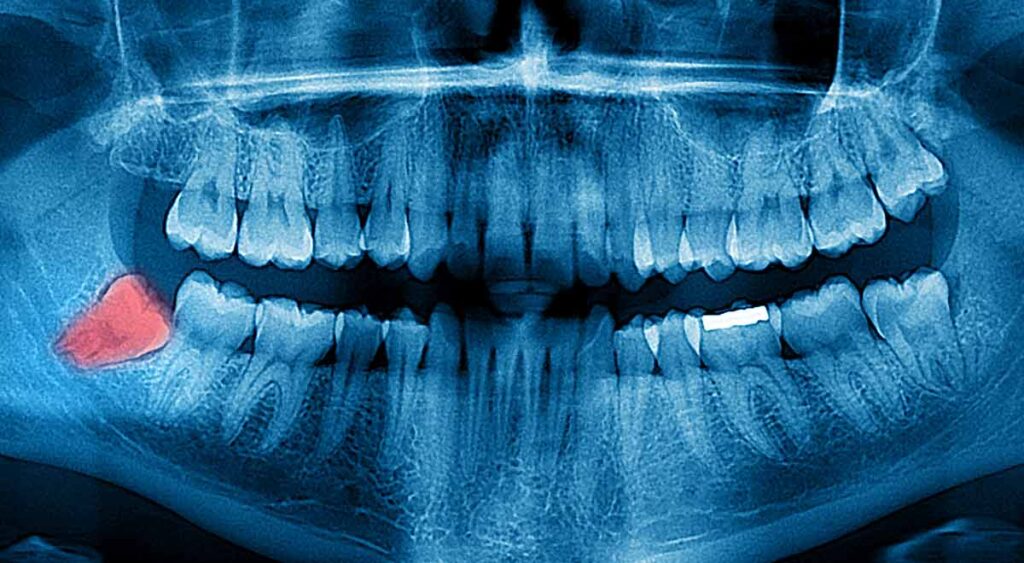 Wisdom Teeth Removal X-ray