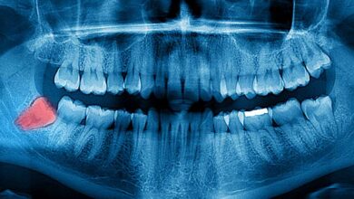 Wisdom Teeth Removal X-ray