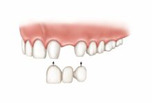 Bridge-or-Implant