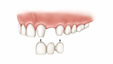 Bridge-or-Implant