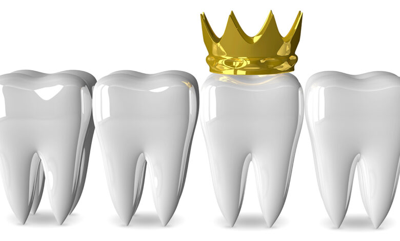 Quality-Dental-Sydney-115-dental-crowns