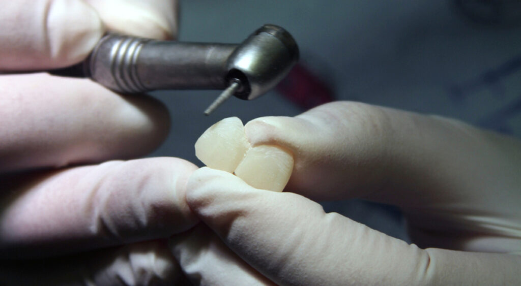 Quality-Dental-Sydney-118-dental-crowns