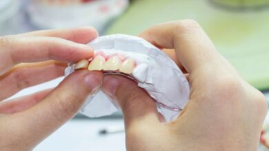 Quality-Dental-Sydney-182-Dental-Bonding