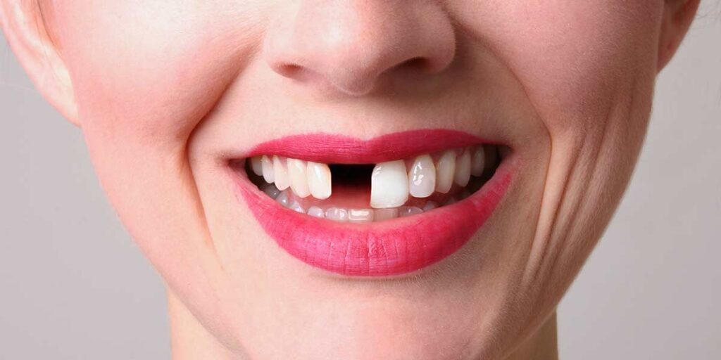 Quality-Dental-Sydney-missing-tooth