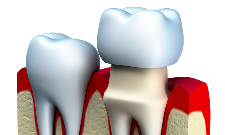 dental-crown-procedure