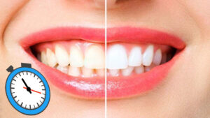 whitening teeth in hour