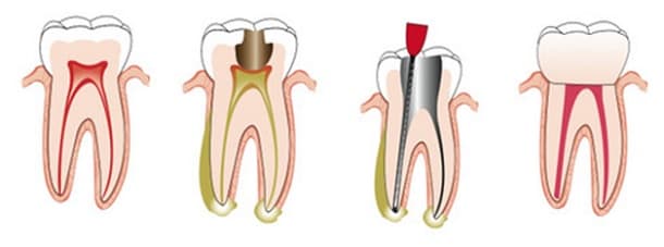 Root Canal Treatment